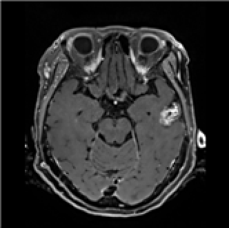 뇌전이암 진단 및 치료 영상-데이터 실제 예시_1_원천 데이터(Enhaced T1 MRI)