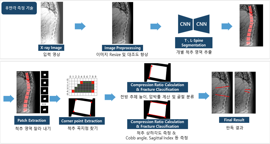 폐경 후 여성 및 60대 이상의 남성의 골밀도(BMD)-후만각 측정 기술_1