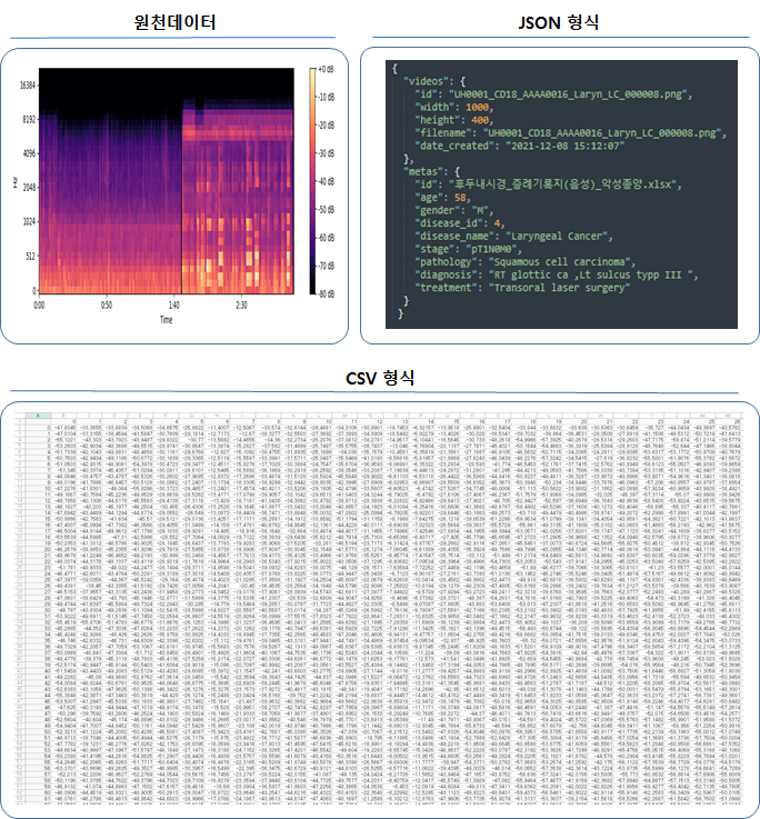 후두질환 판독을 위한 후두 내시경 데이터-데이터 포맷_2