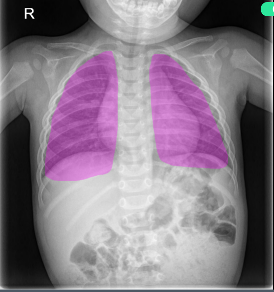 소아 흉부 이미지 데이터-질환별 라벨링 예시_5_과다팽창