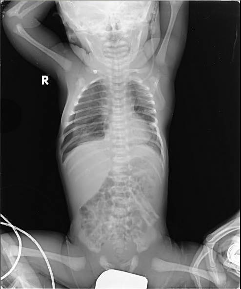 소아 흉부 이미지 데이터-원본 및 라벨링 데이터 예시_1_원본 데이터(dicom)