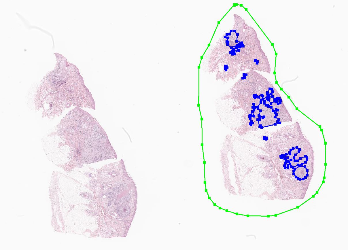 - 기저세포암 (Basal cell carcinoma)